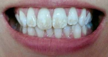 fluorosis-