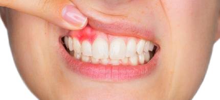 gum-disease-