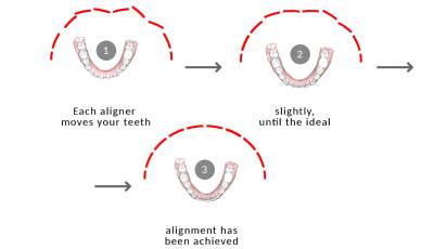 how-does-a-aligner-work