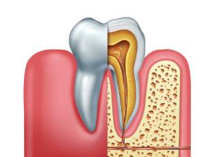 root-canal-treatment-causes-infection