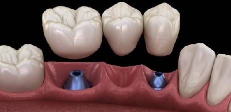 dental-implantation-is-not-generic-