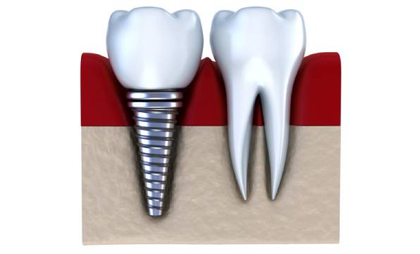 straight-implant-