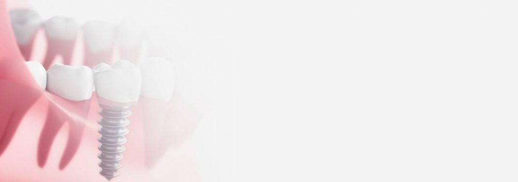 invisible aligners cost in chennai