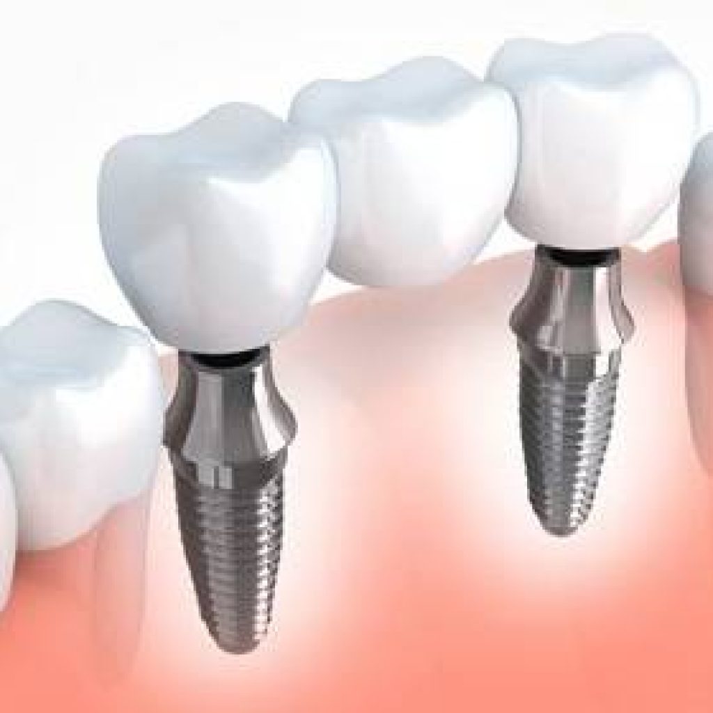Dental Implants in Chennai