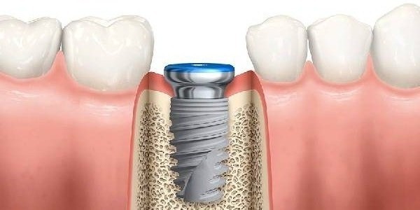 single-piece-implantology