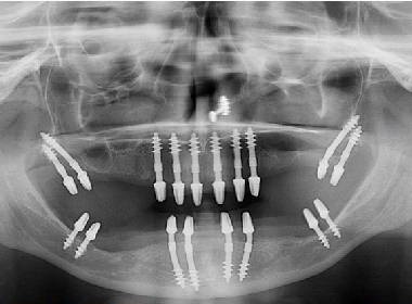 treating-diabetic-with-basal-implantation-