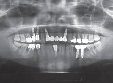 treating-periodontitis-with-basal-implantation