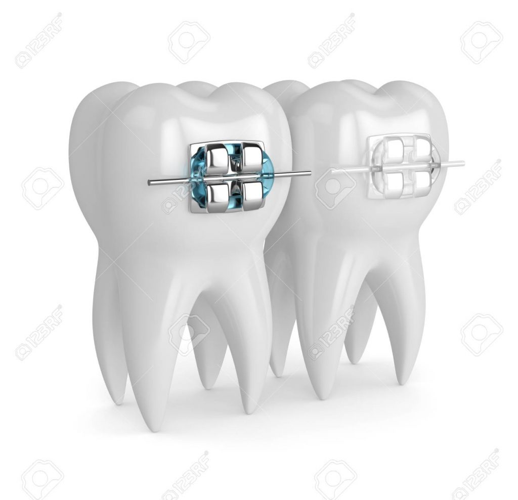 dental implant facts chennai