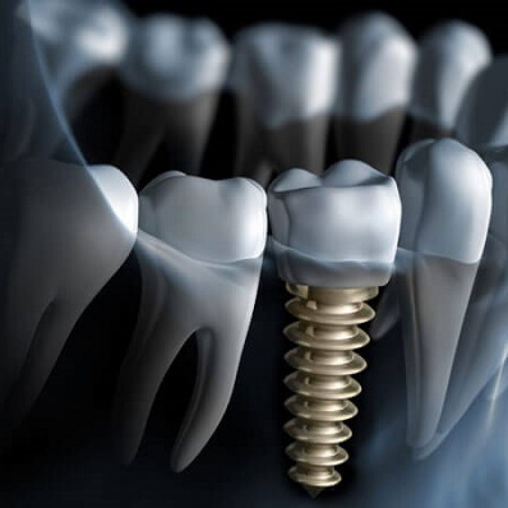 Dental Lab Chennai | Advanced Technology & Precision Work