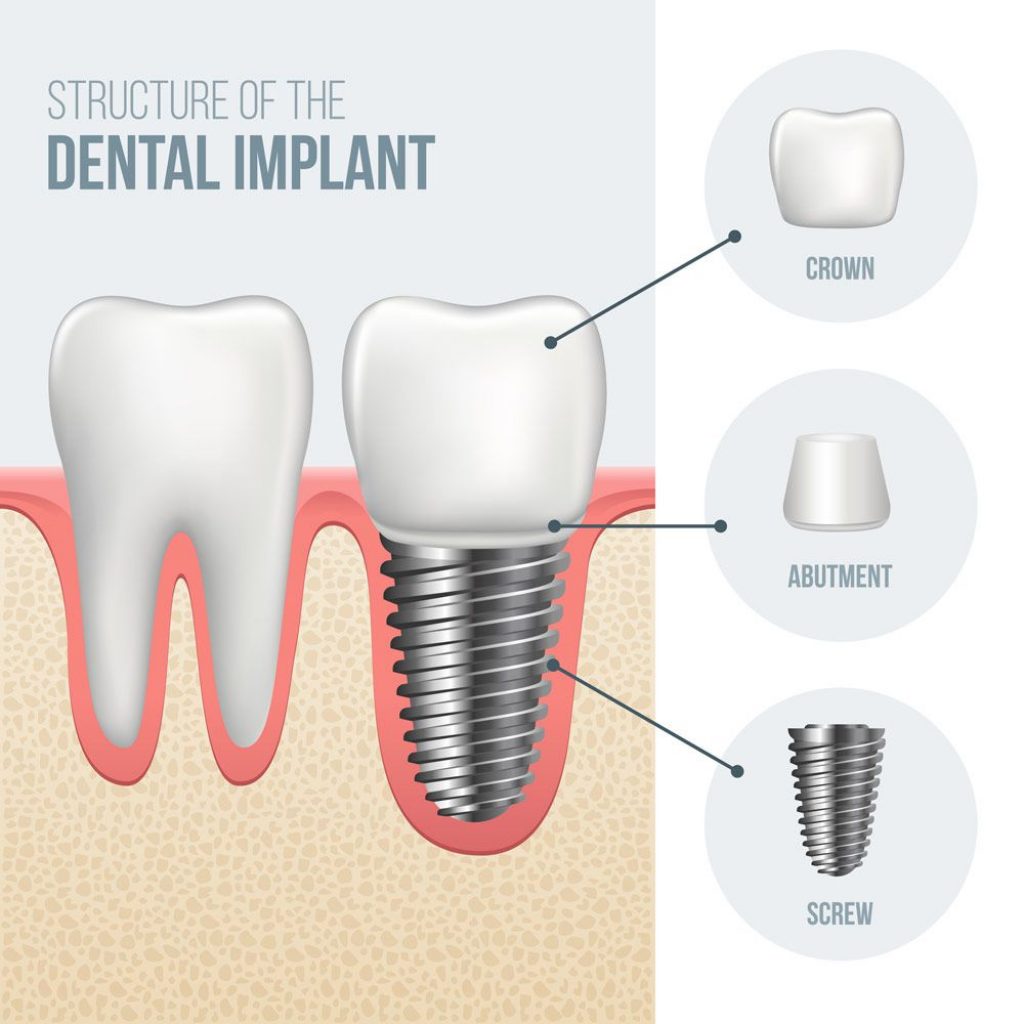 best dental implants in chennai