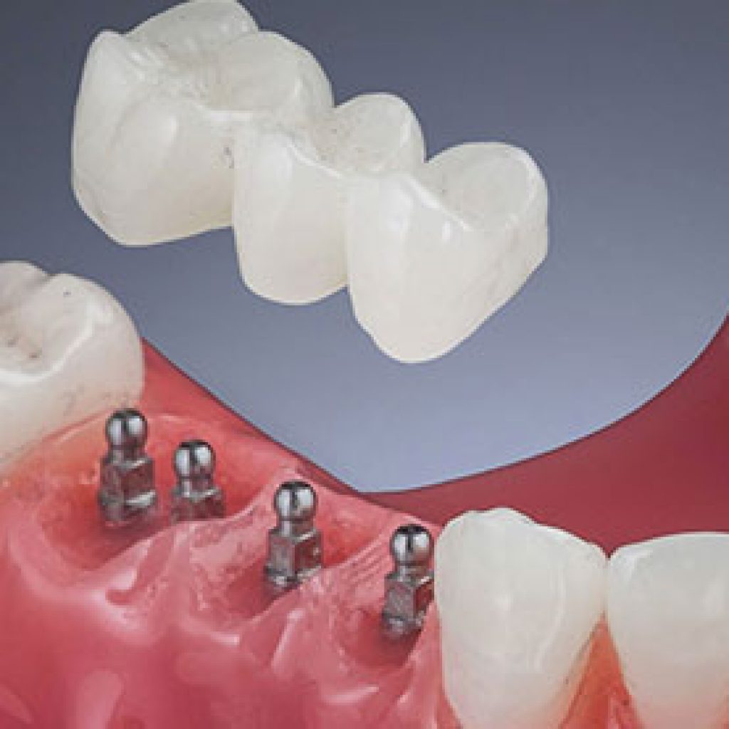 mini dental implants