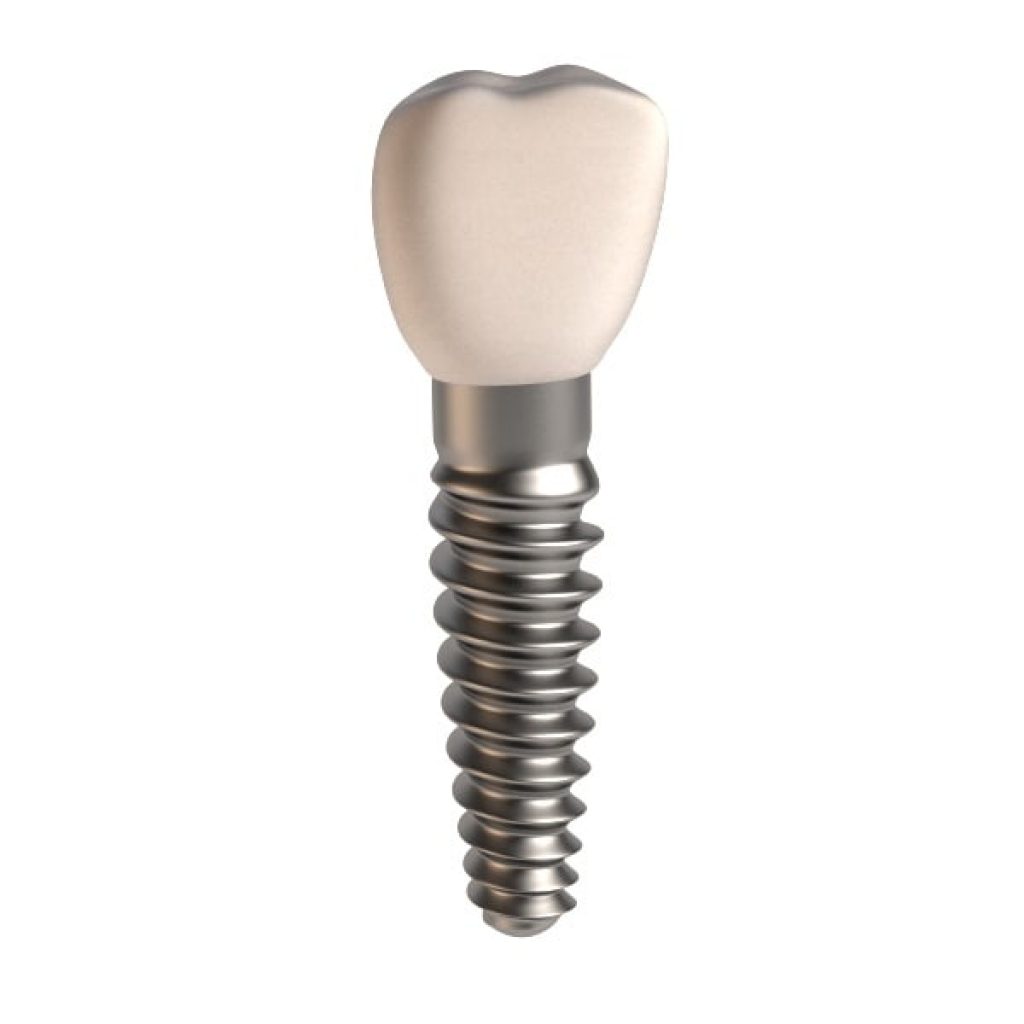 3D dental implant Chennai