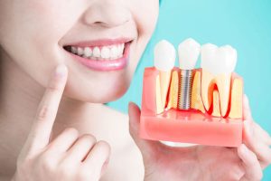 Full Mouth Dental Implants Chennai