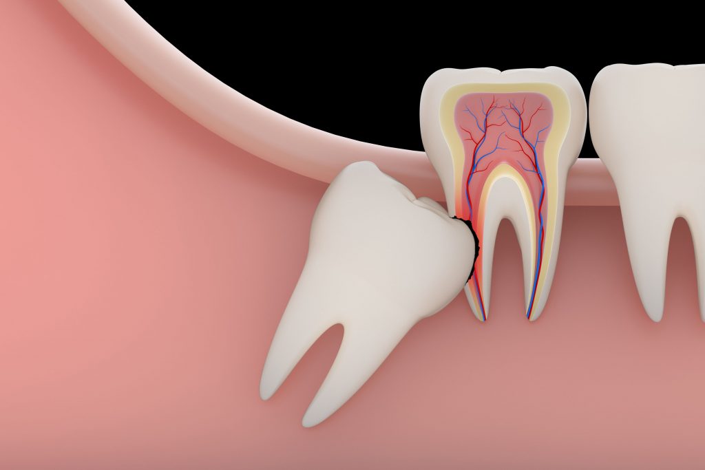 impacted teeth treatment