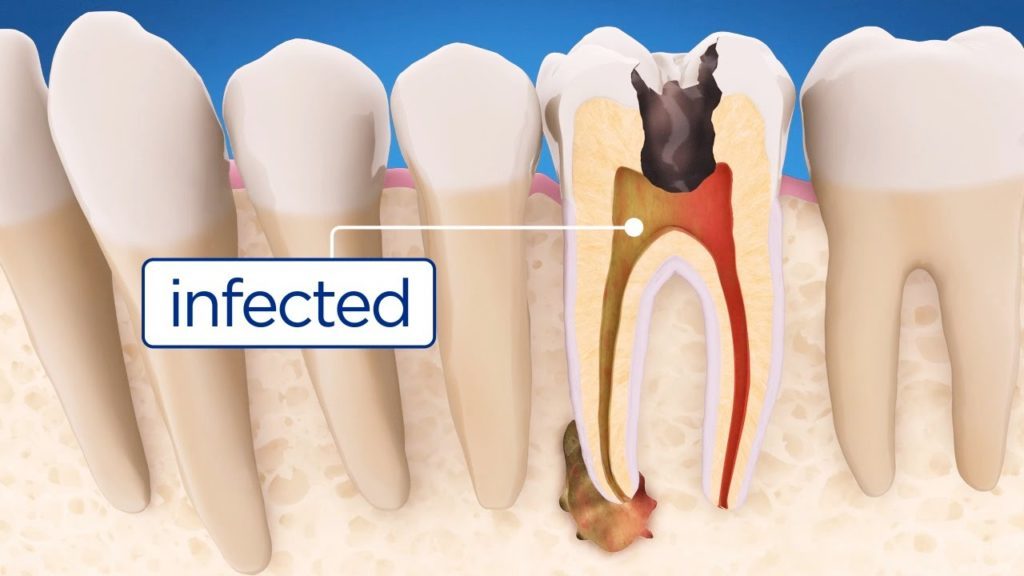 half mouth dental implants chennai cases