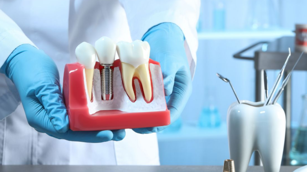 Best Dental Implants in Chennai
