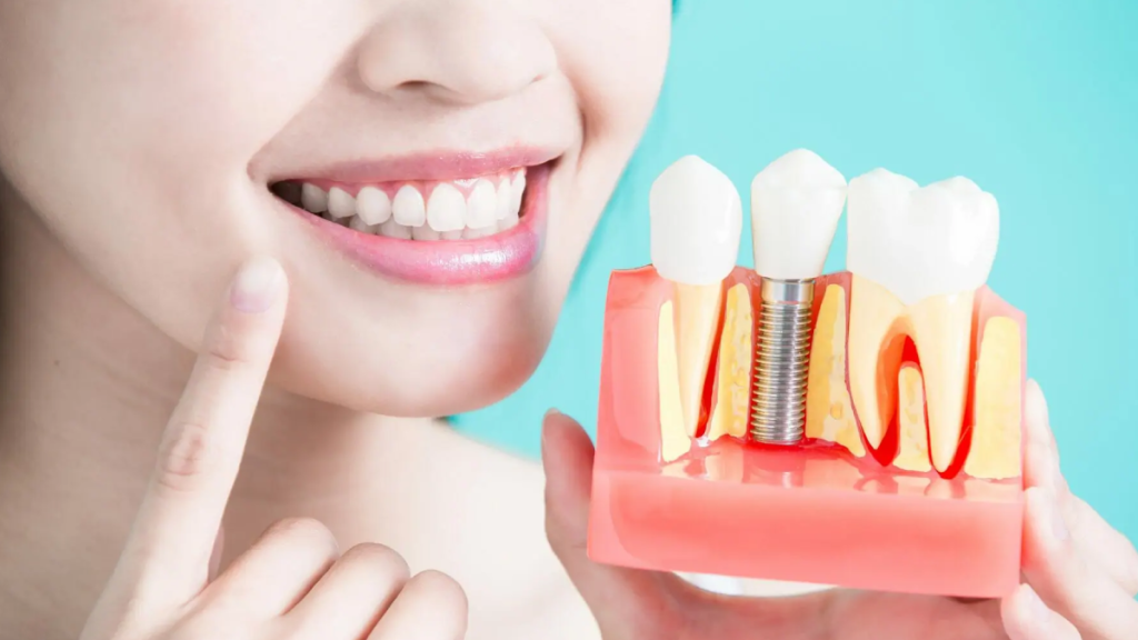 Half Mouth Dental Implants Chennai | Real Case Results