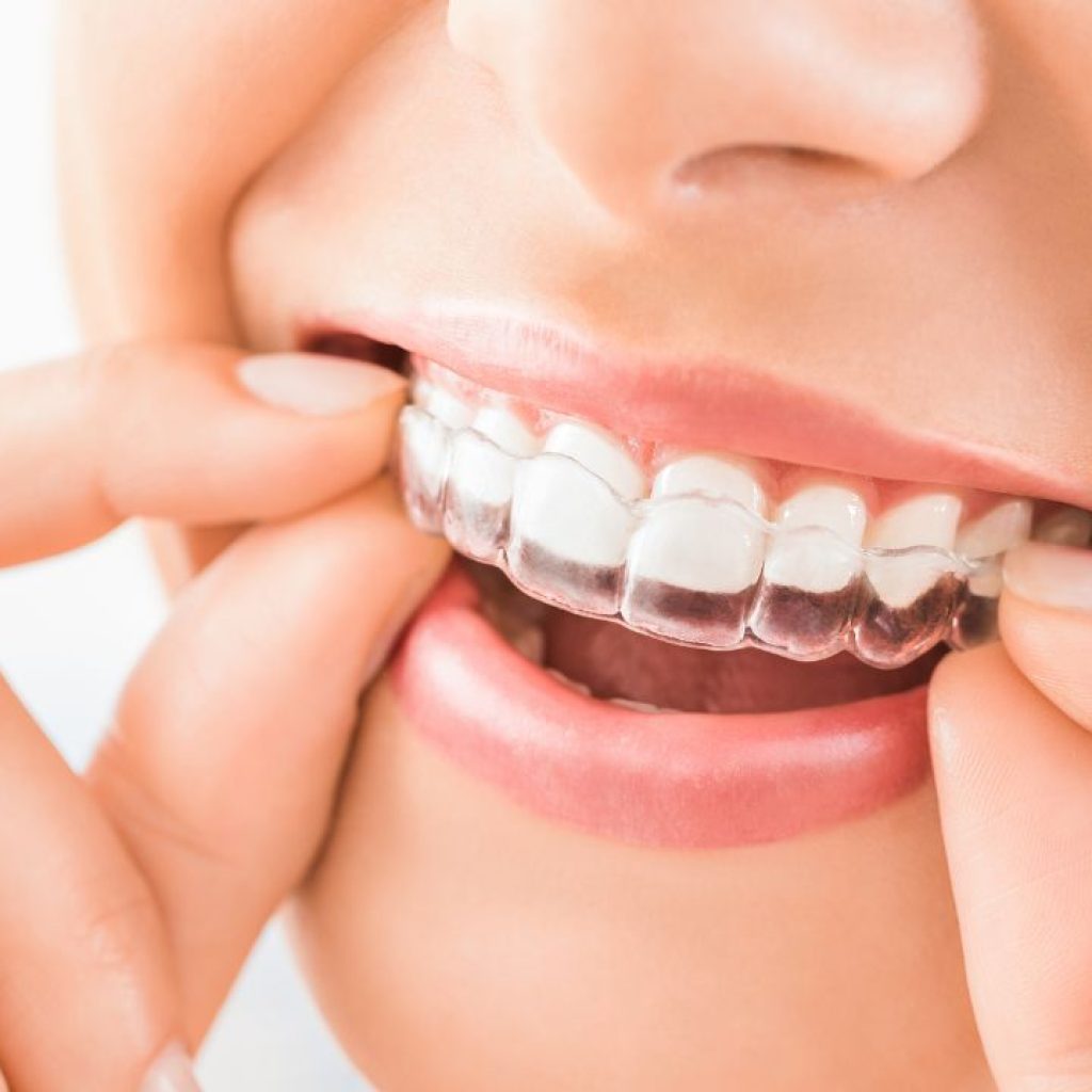 clear aligners in chennai