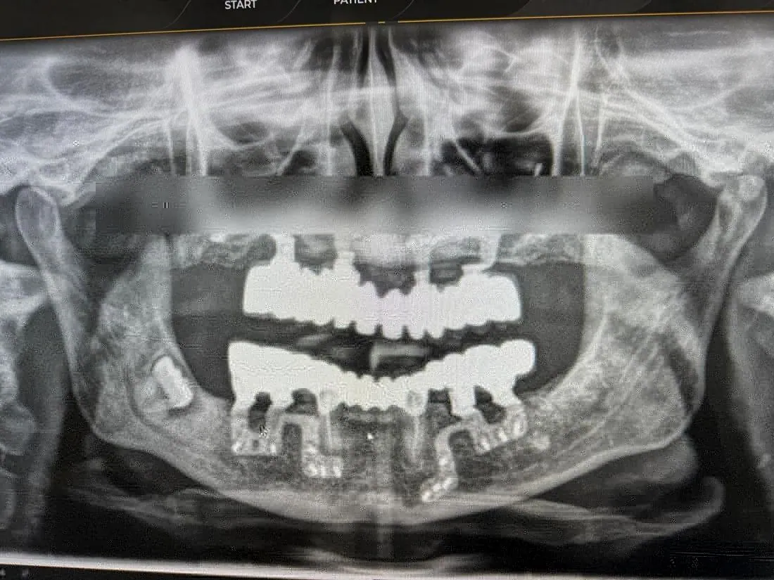 Panoramic X-ray showing implants and restorations