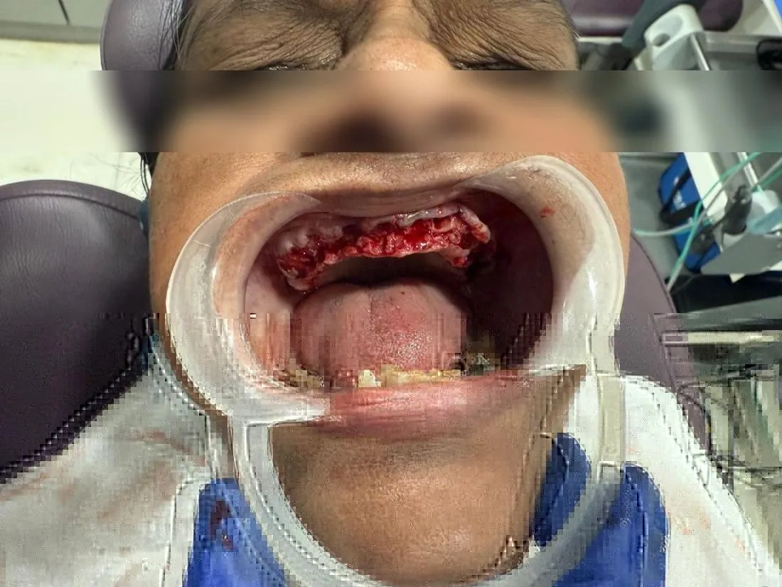 Upper jaw during implant surgery