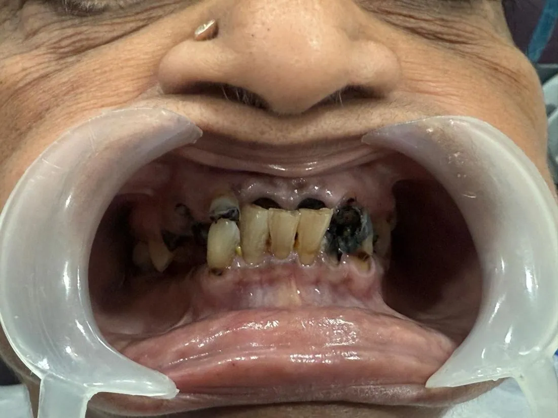 Before treatment: decayed front teeth
