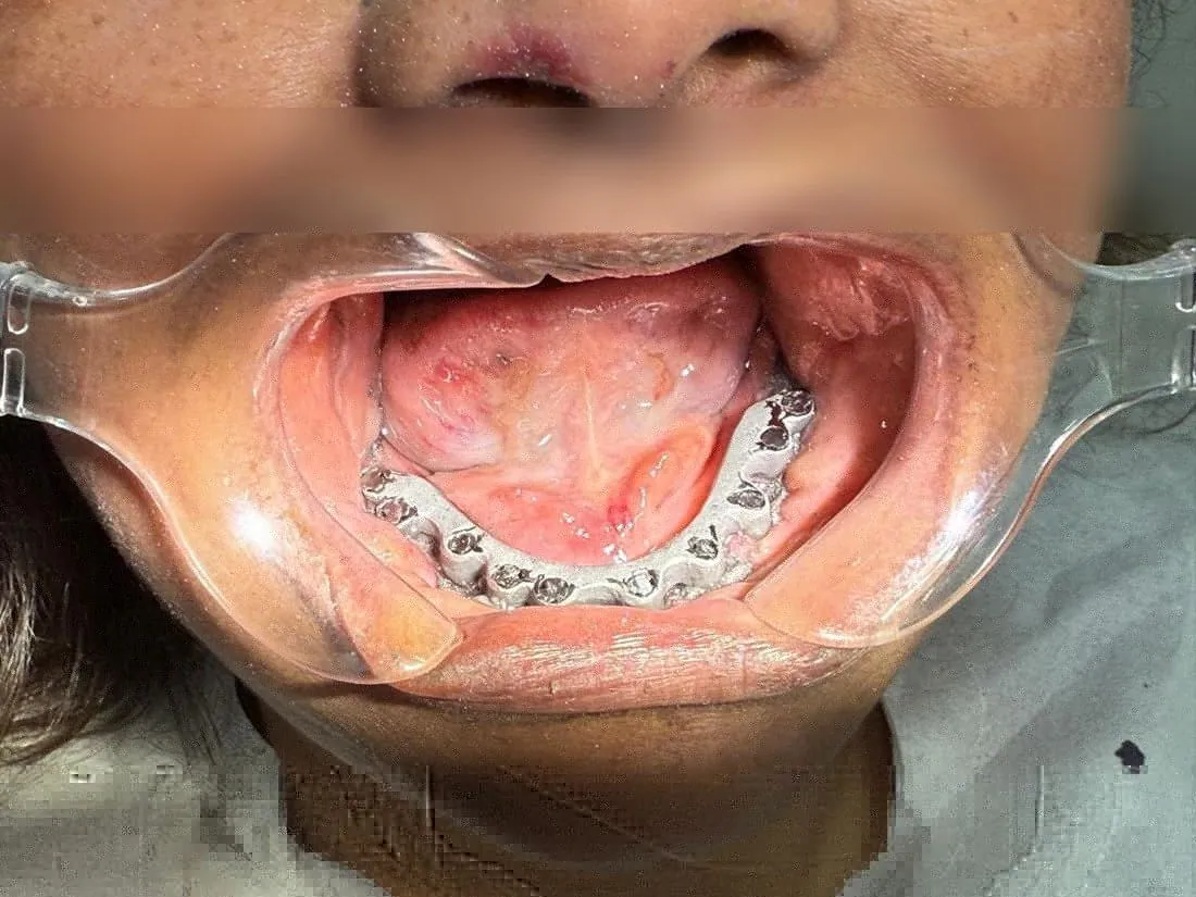Lower jaw with metal framework