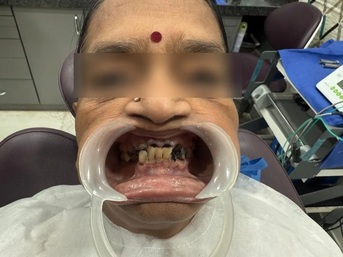 Before treatment: worn upper teeth, eyes blurred