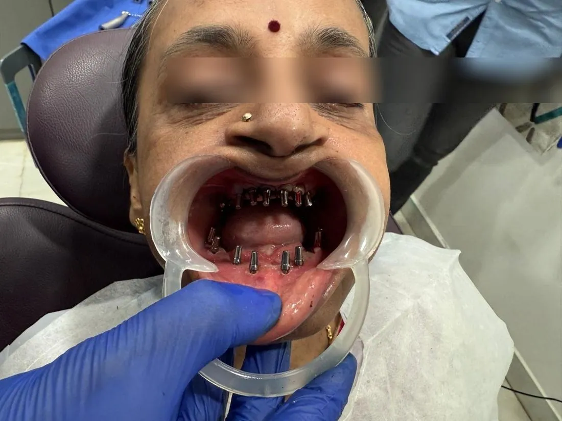 Dark implant components seen in the mouth, eyes blurred