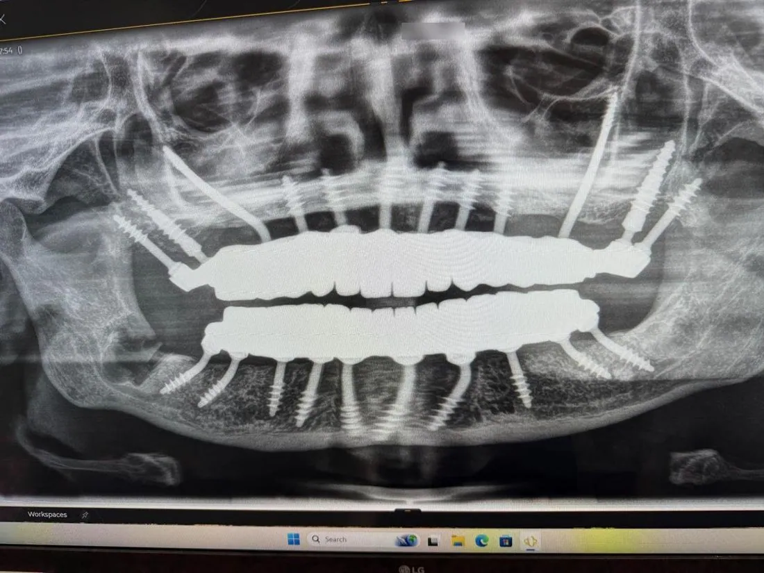 Panoramic X-ray with implant-supported bridge