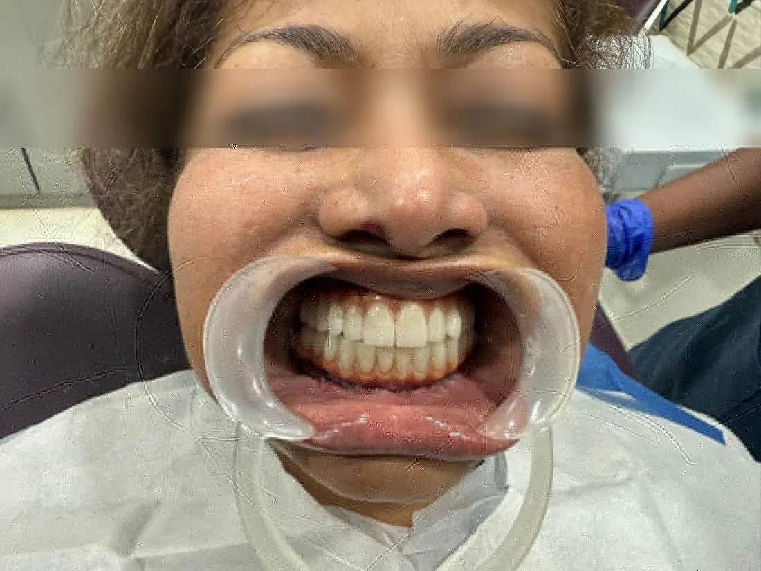 Patient smiling with new upper and lower teeth, eyes blurred