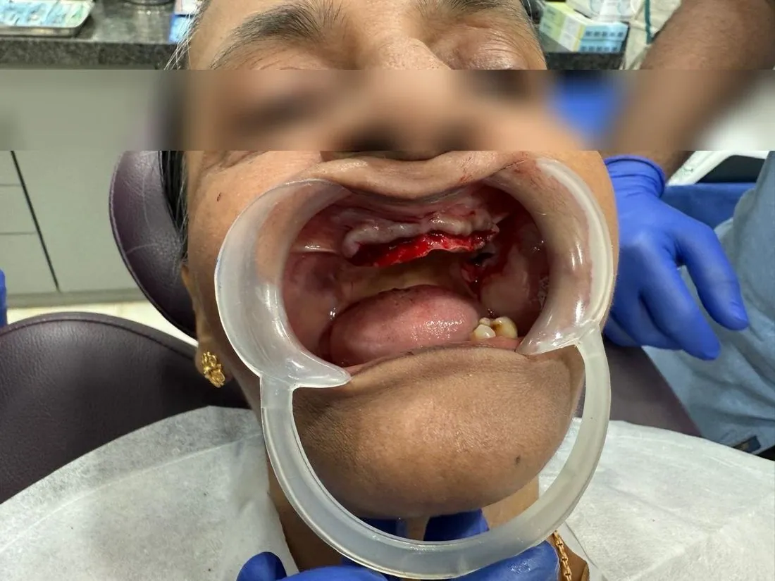 Upper jaw surgical site, eyes blurred