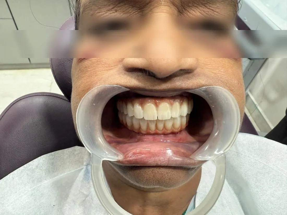 New upper and lower teeth after implant treatment, eyes blurred