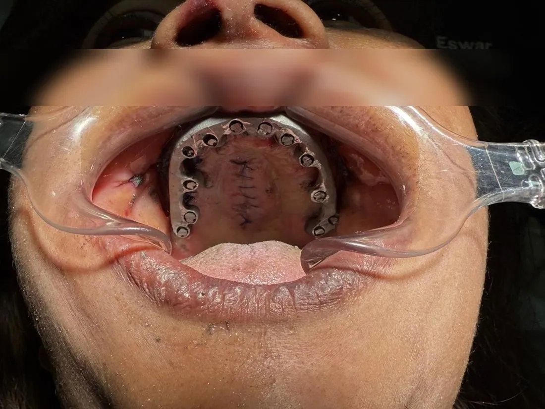 Upper jaw with metal framework and sutures