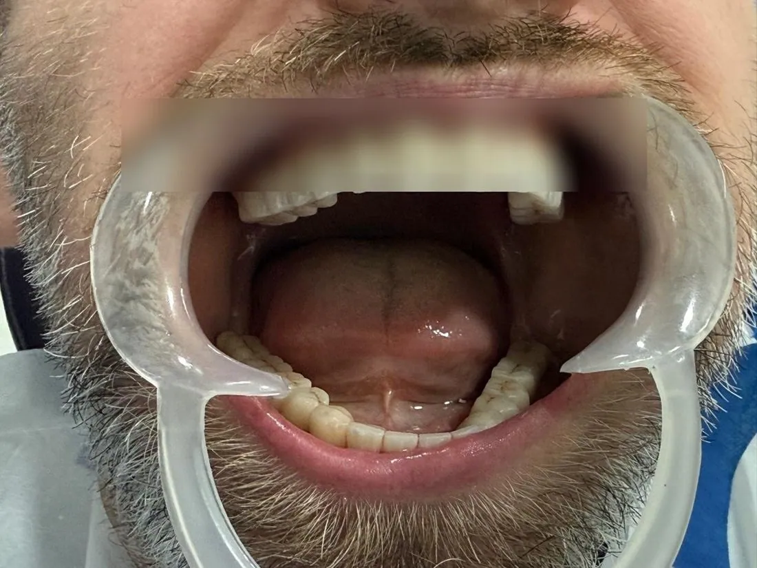 New upper teeth with mouth open wide