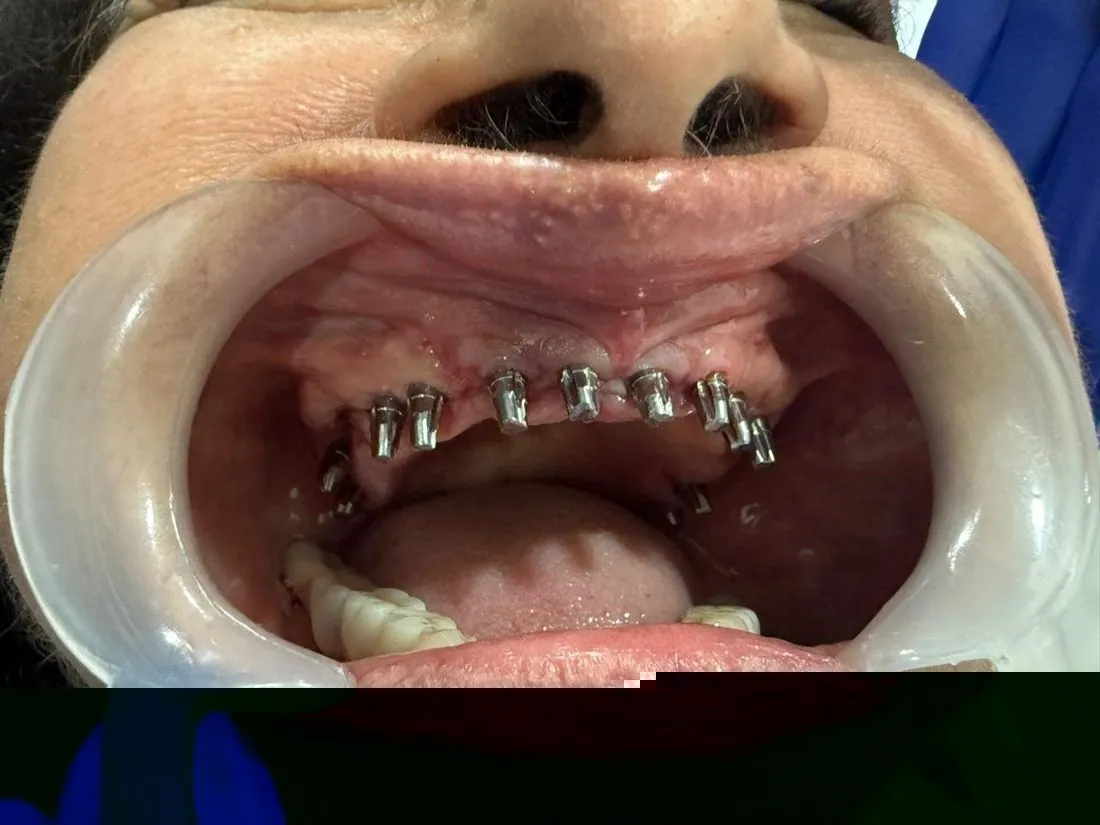 Upper jaw with implant abutments placed