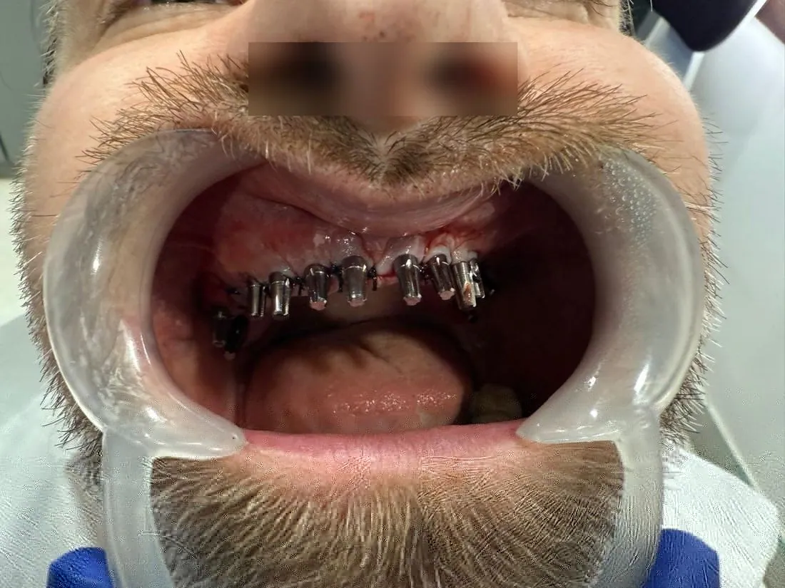 Upper jaw with implant abutments placed