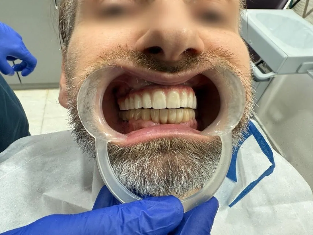 Patient smiling with new implant-supported teeth, eyes blurred