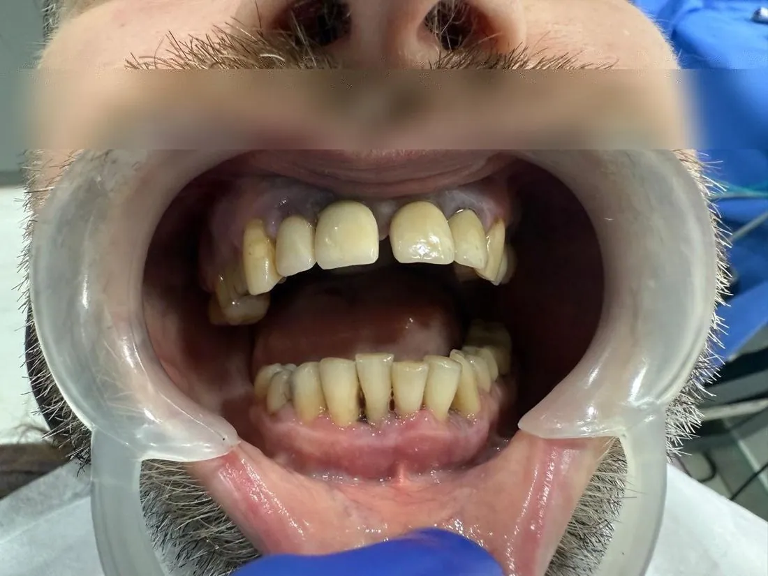 Before treatment: natural teeth with gaps, eyes blurred