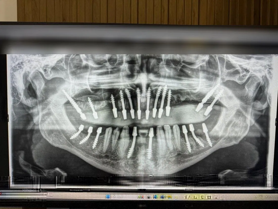Panoramic X-ray showing dental implants