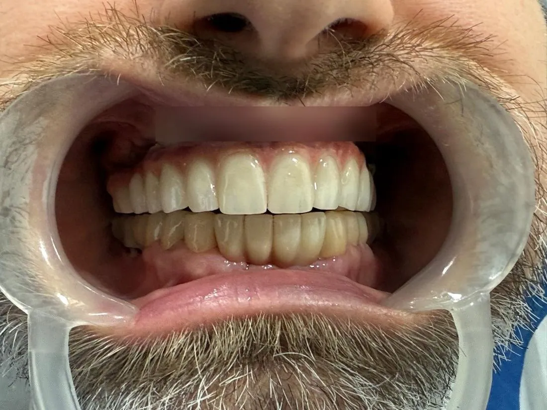 Close view of new upper teeth after implant treatment