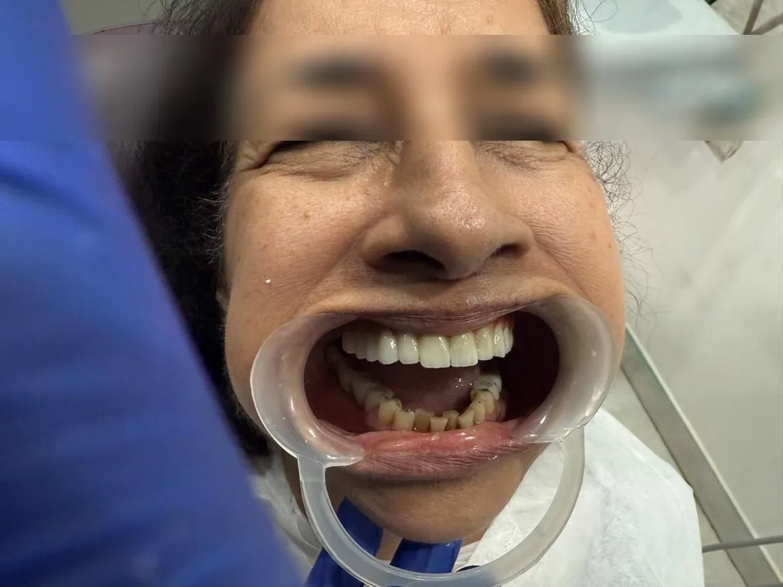 Patient smiling with cheek retractor, eyes blurred