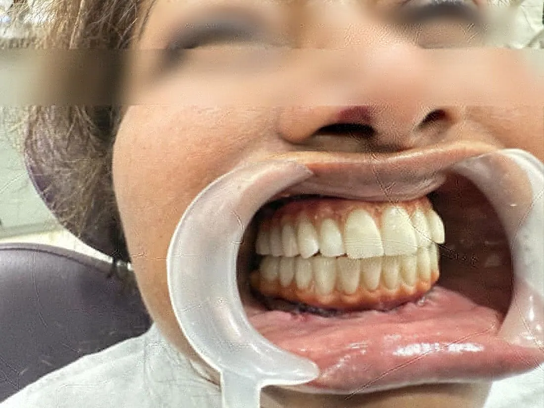New upper teeth seen with cheek retractor, eyes blurred