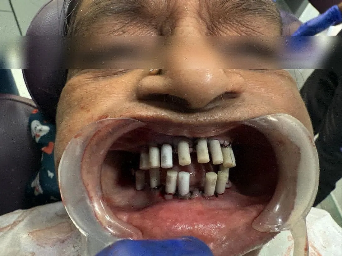 Prepared abutments in upper and lower jaw, eyes blurred