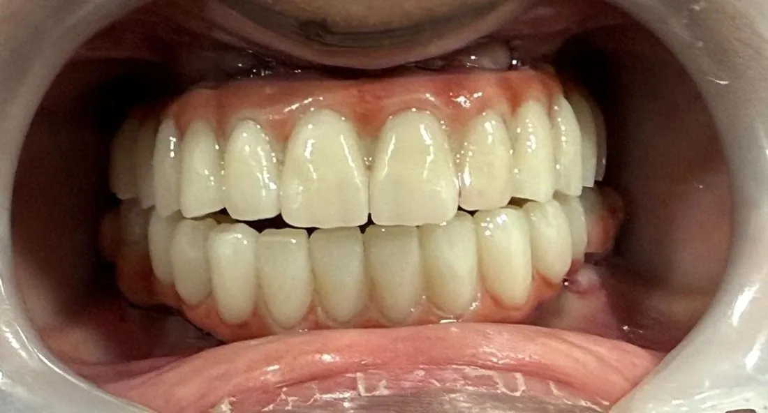 Close view of finished upper and lower teeth