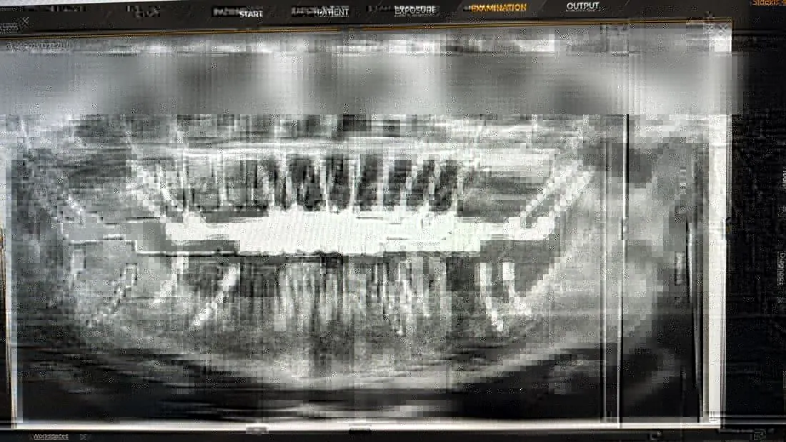 Panoramic X-ray with implant-supported bridge