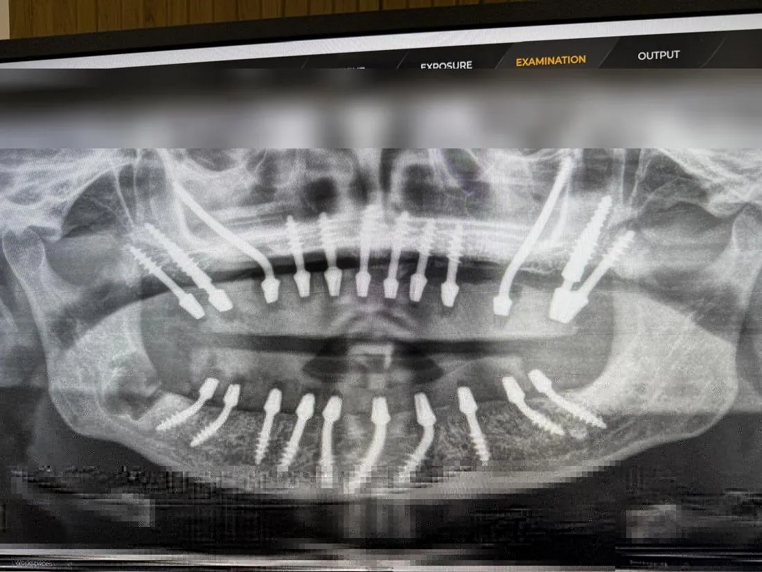 Panoramic X-ray of upper and lower implants