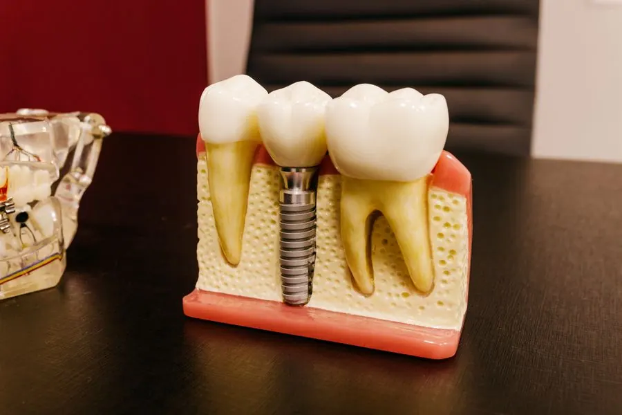 No bone grafts required