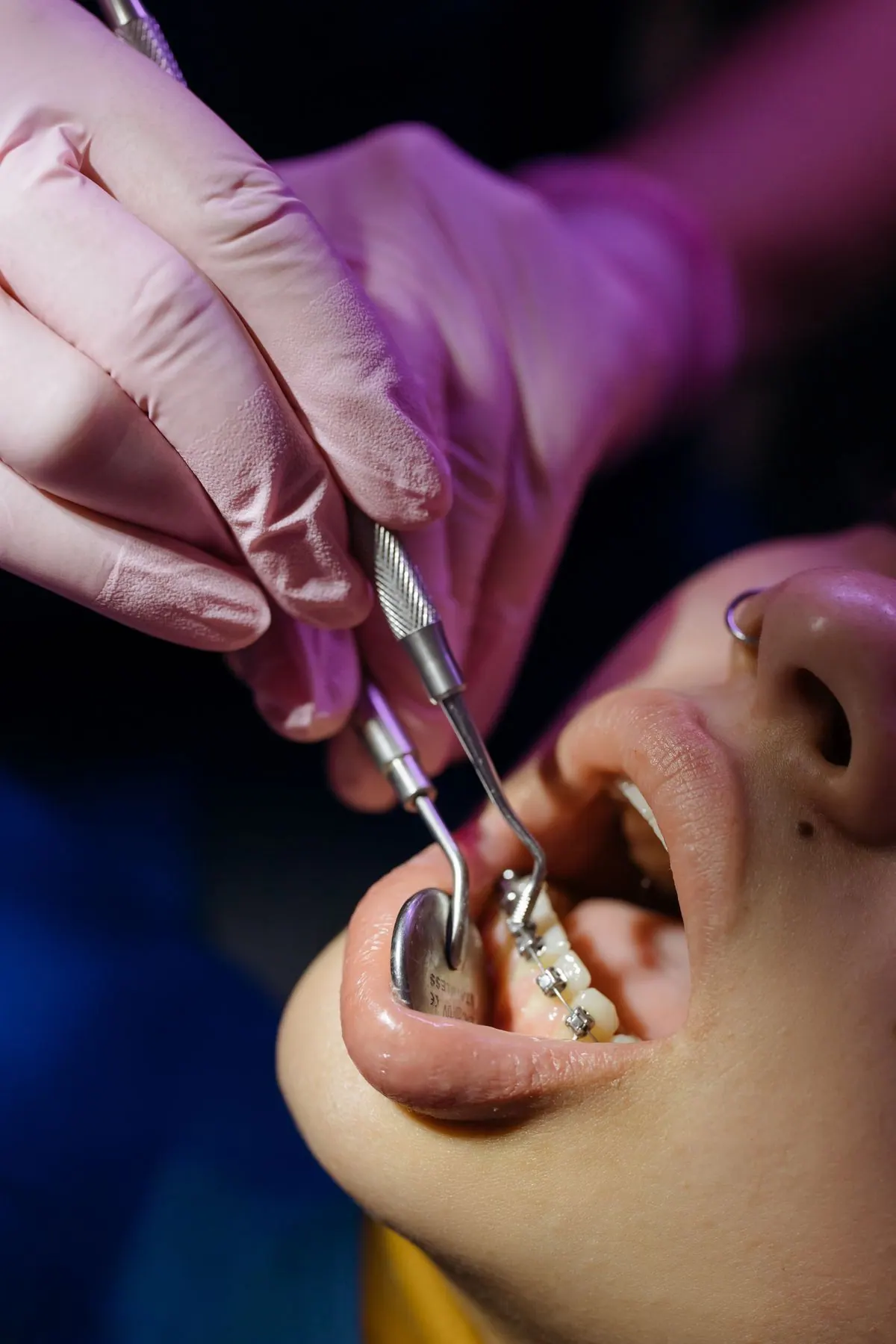 Aligner care and maintenance