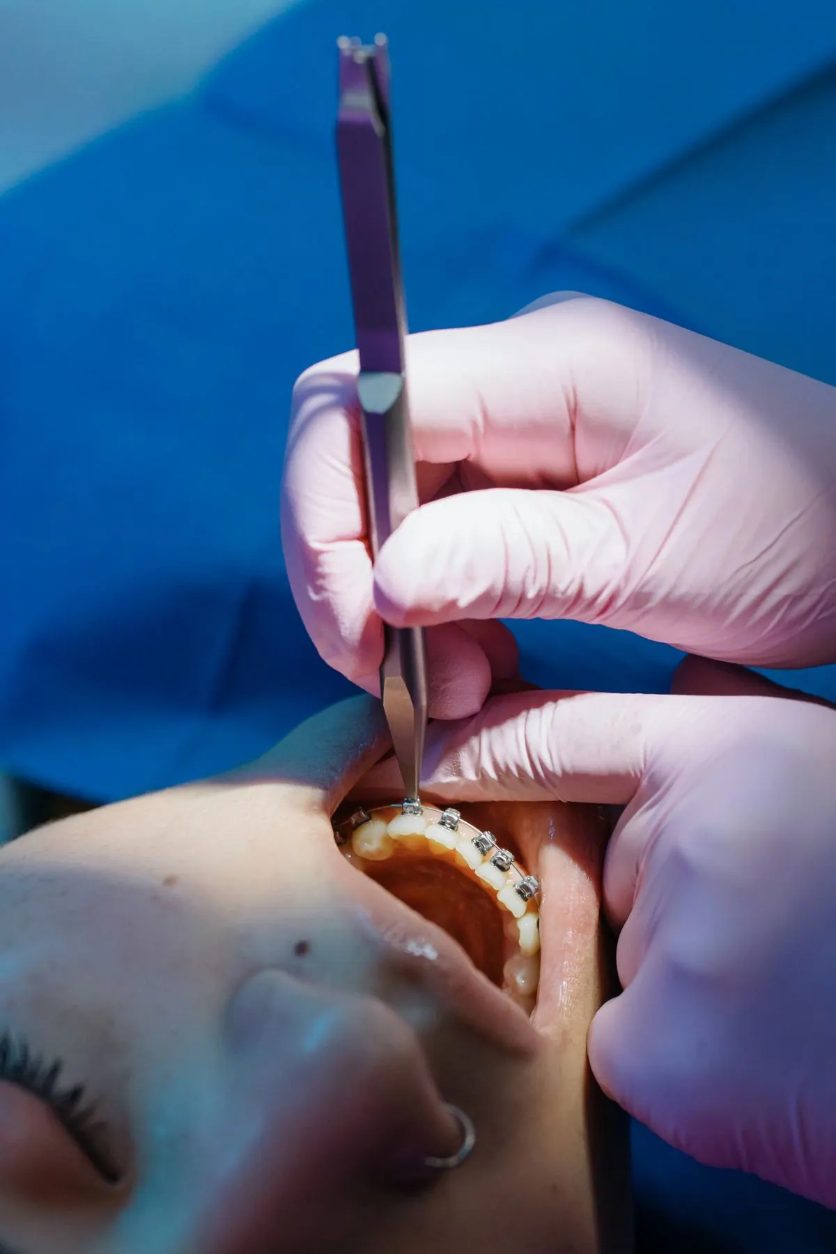 Orthodontic braces treatment