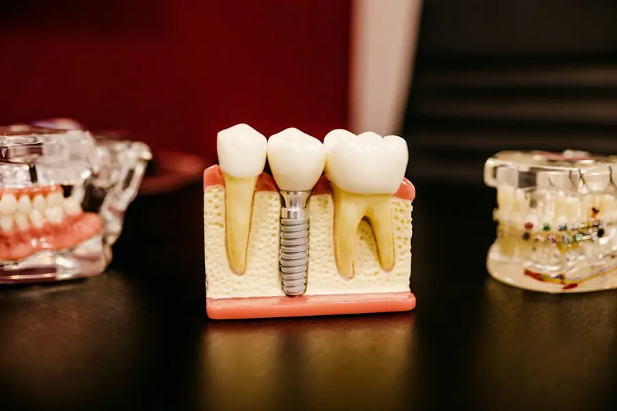Dental implant model showing fixed replacement teeth